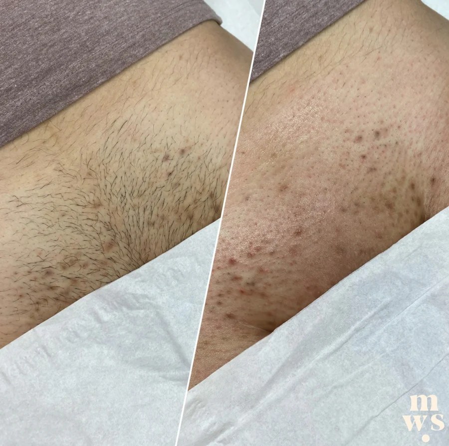 How to exfoliate after brazilian wax