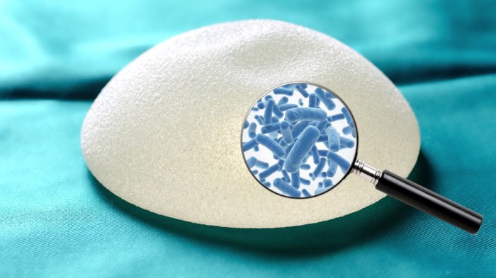 How to avoid capsular contracture