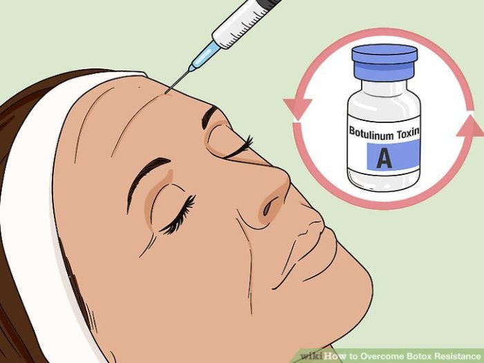 Botox resistance overcome How to overcome botox resistance