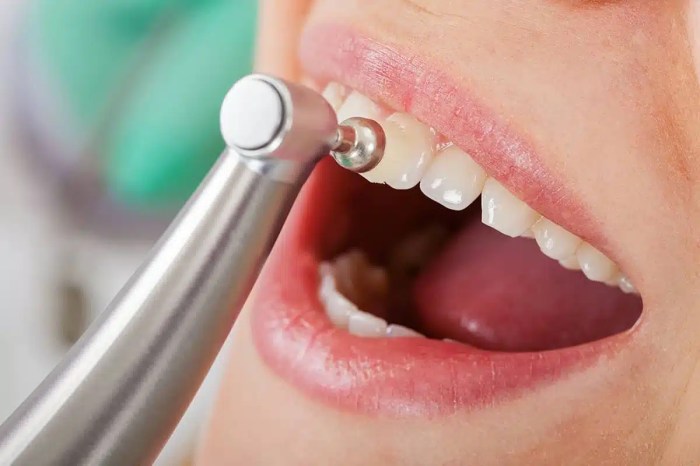 How to clean all on 4 dental implants