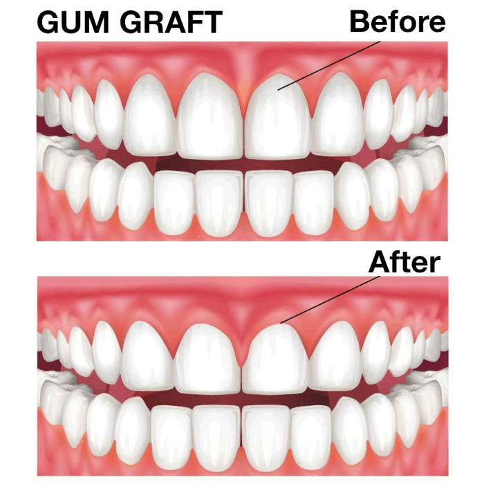 How long does a gum graft take to heal