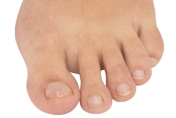 How long does it take an ingrown toenail to heal
