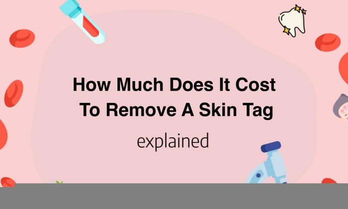 How much does it cost to remove a skin tag