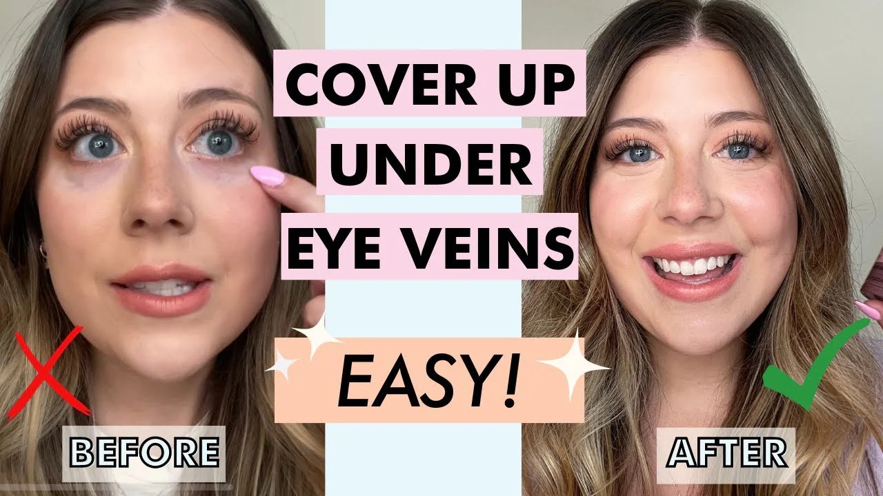 How to get rid of veins under eyes