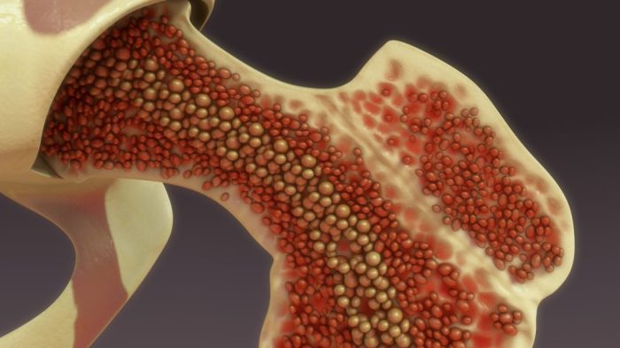 How to Fix a Failed Cervical Fusion A Guide
