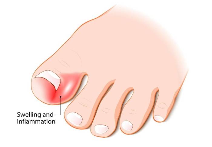 How long does it take an ingrown toenail to heal