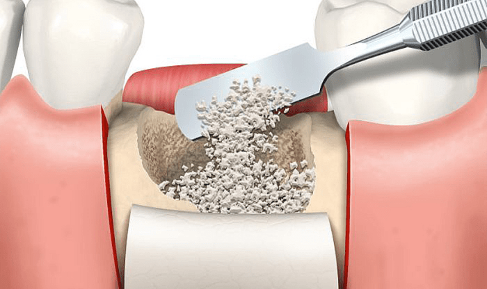 Graft bone heal typically does dental How long does a bone graft take to heal