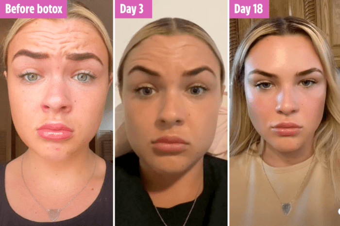 How long does masseter botox take to work