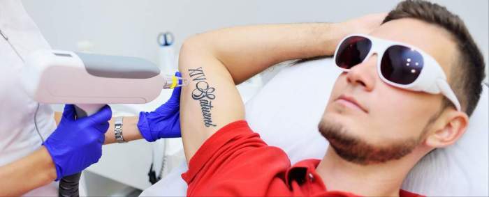 How much does it cost to remove a small tattoo