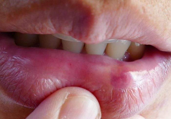 Biting