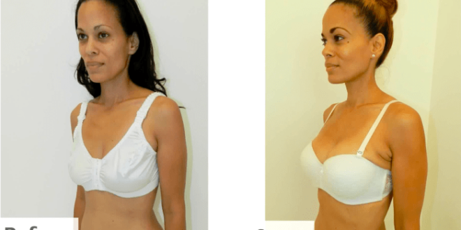 Breast lift after weight loss insurance coverage