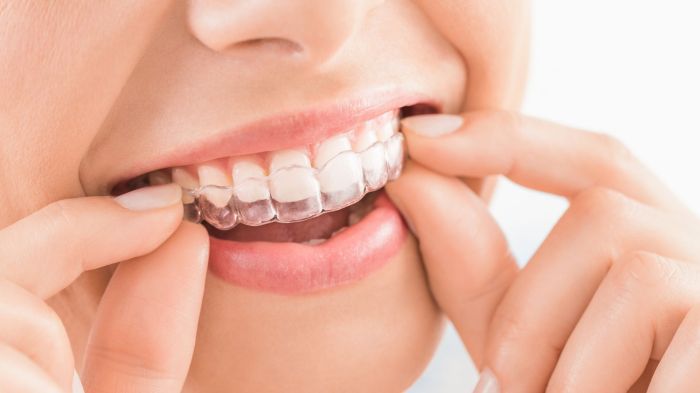 How long does invisalign take to fix overbite