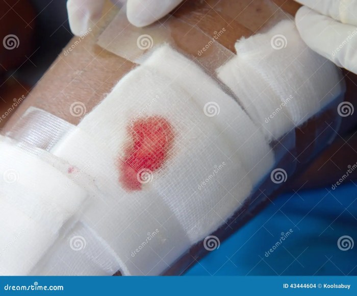 How to remove stuck gauze on wound