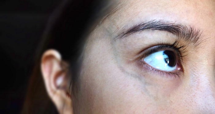 How to get rid of veins under eyes
